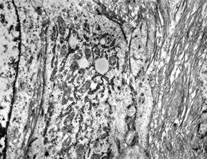F,17y. | neck - rhabdomyosarcoma F,17y. | neck - rhabdomyosarcoma